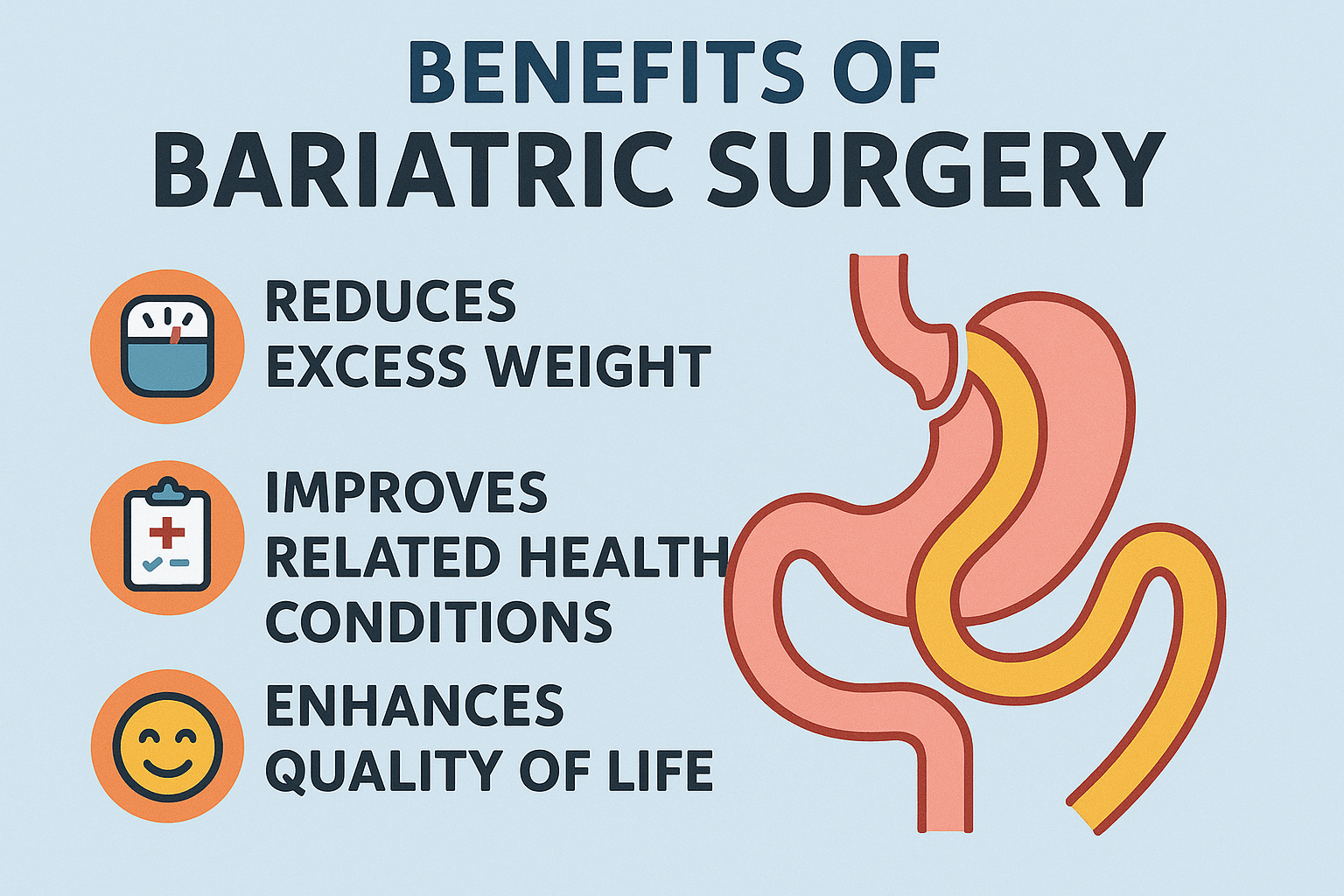 Illustration of Gastric Sleeve procedure