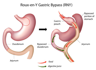 Classic Gastric Bypass (Roux-en-Y)